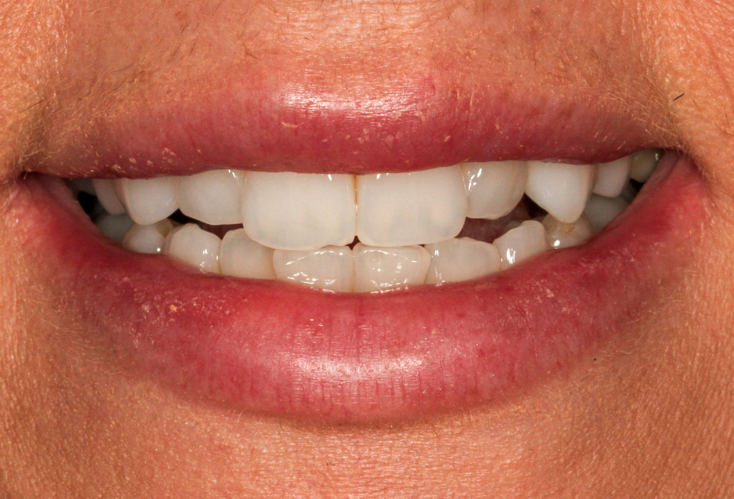 home teeth whitening kits uk