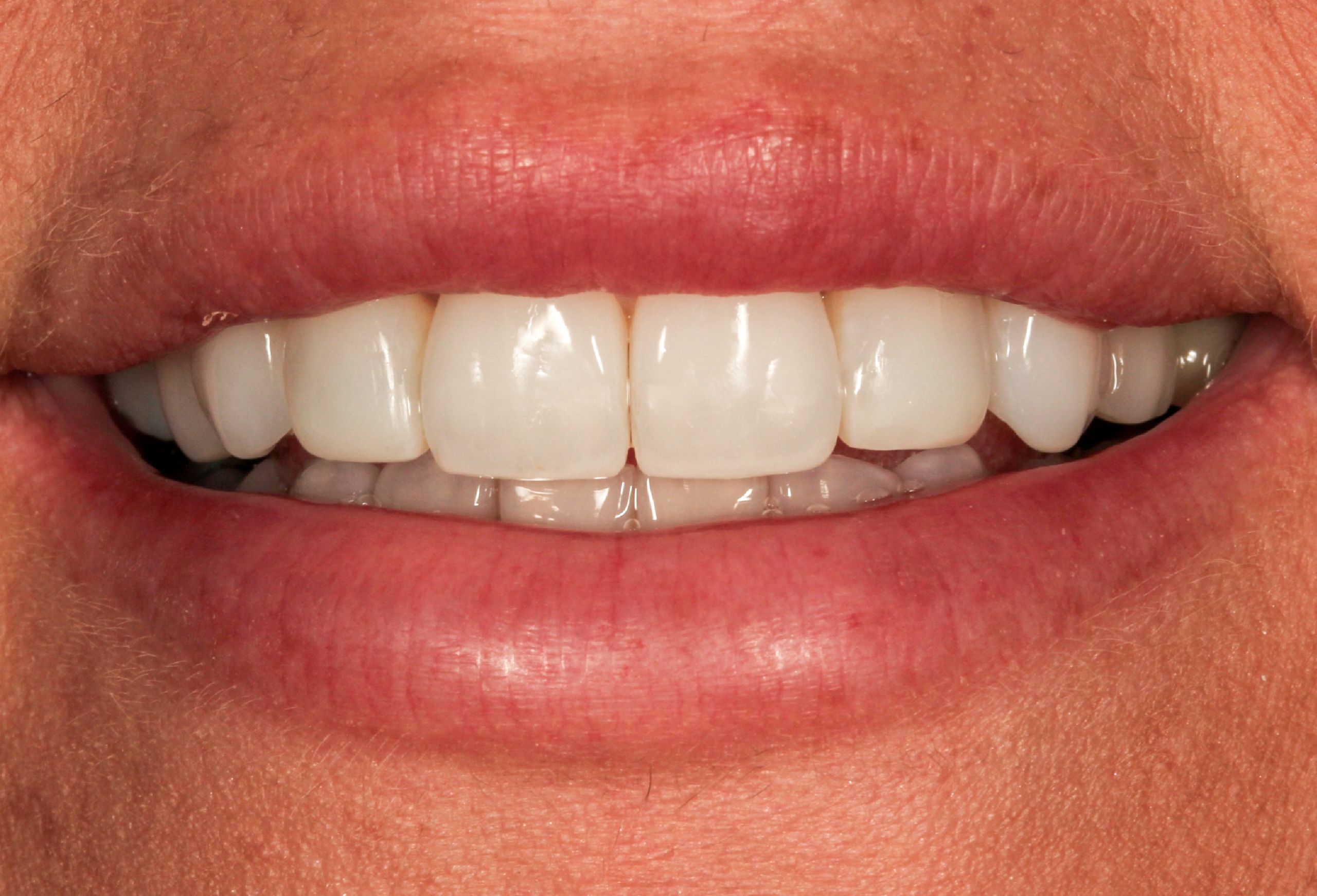 dentist teeth whitening uk