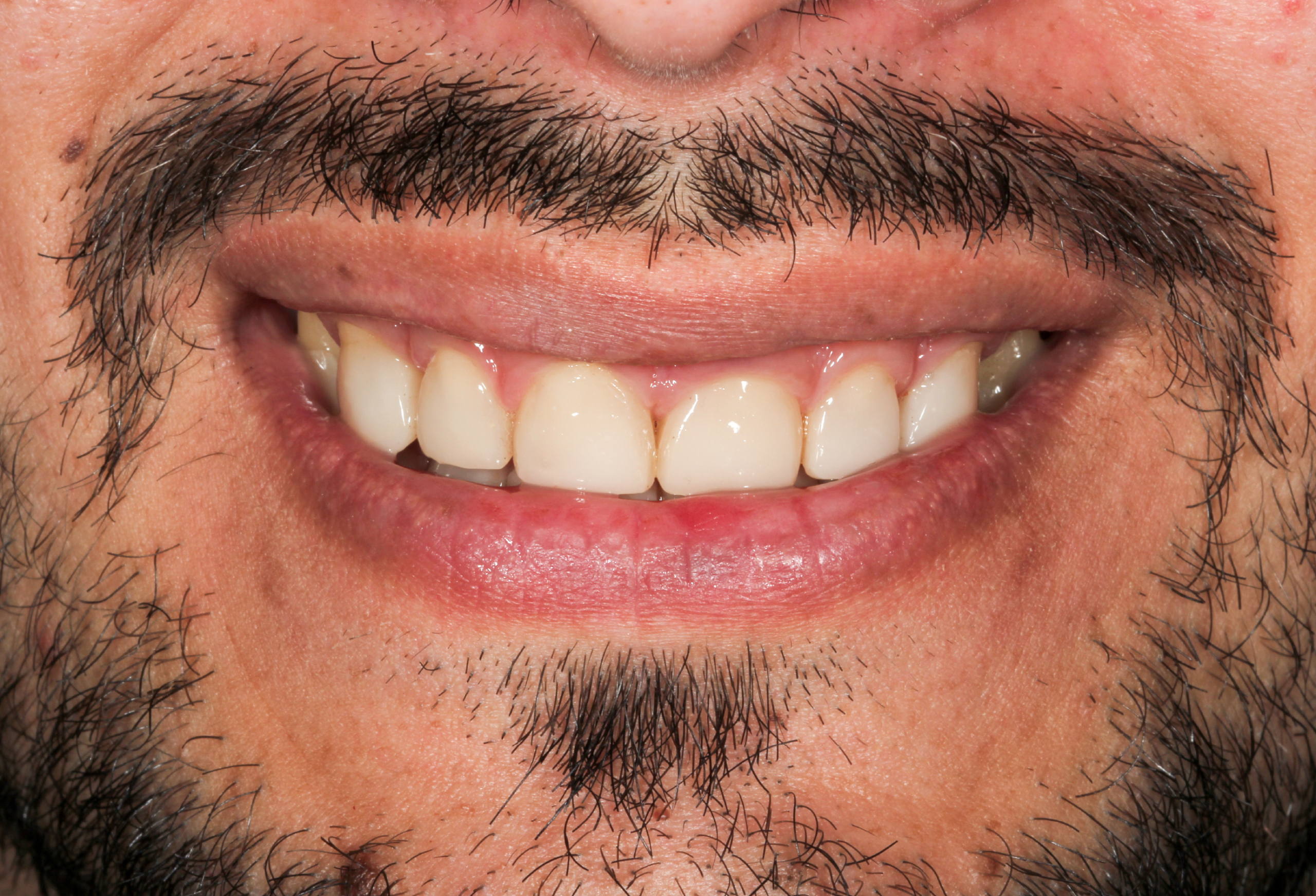 best teeth whitening uk